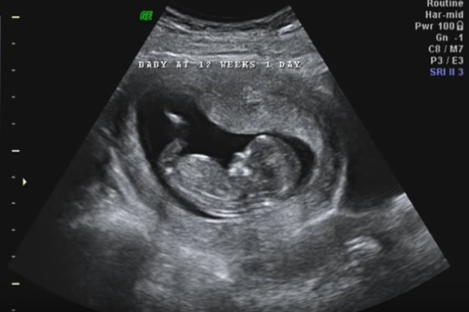 Phôi thai 12 tuần đã trở thành thai nhi 