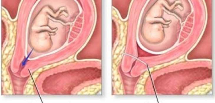 khi bước sang tuần thai thứ 24, cổ tử cung thấp của bạn sẽ dài khoảng 35mm. Đây là lúc phát hiện ra dấu hiệu cổ tử cung thấp khi mang thai 
