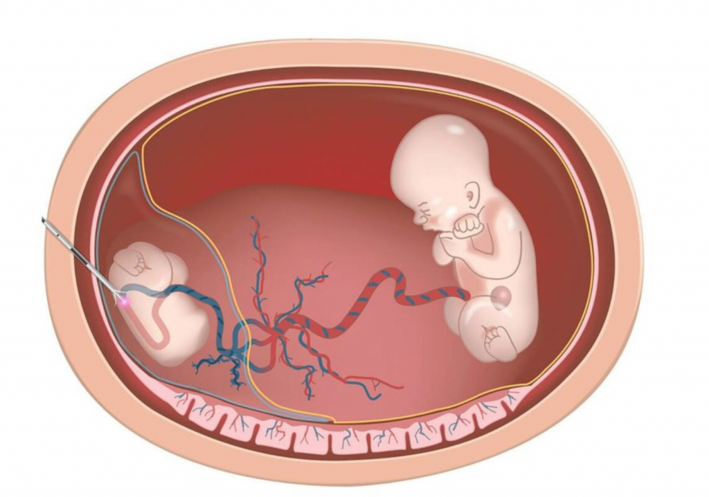 Sự thoái hoá 1 bào thai so với anh em do không phát hiệu dấu hiệu có thai sớm 