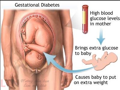 đường trong máu sẽ tăng cao Điều này tất yếu dẫn tới các dấu hiệu bệnh tiểu đường ở phụ nữ mang bầu