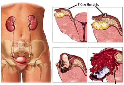 Mang thai ngoài tử cung là hiện tượng phôi thai phát triển bên ngoài tử cung