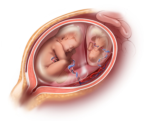 Trong một số trường hợp, dấu hiệu mang thai đôi một trong hai bào thai có thể bị sẩy hoặc biến mất