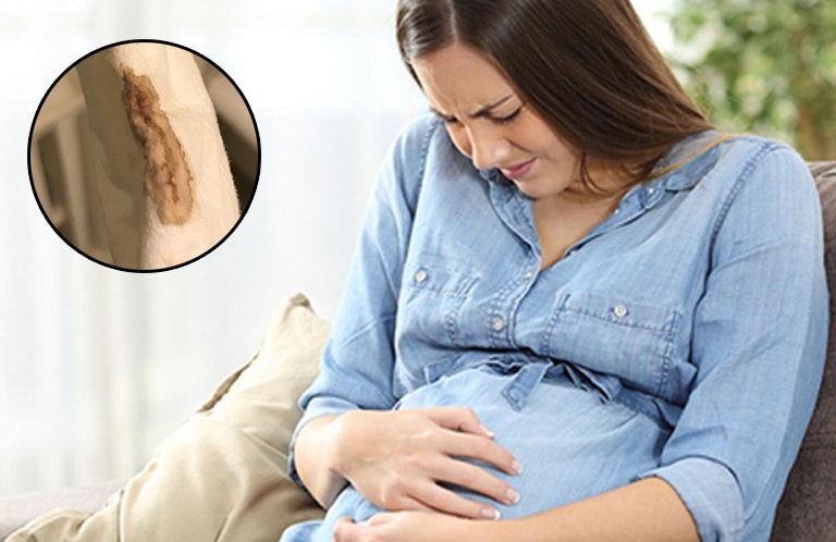khí hư màu nâu khi mang thai còn xảy ra ở những chị em bị rối loạn nội tiết tố